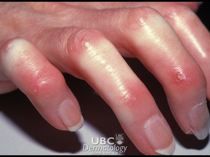 connective disease-2 scleroderma