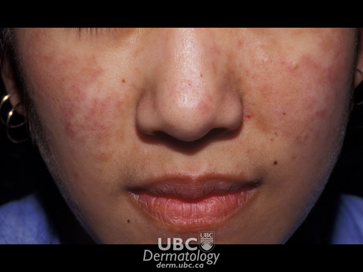 connective disease-3 lupus