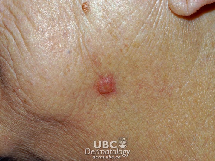 skincancer3-SquamousCellCarcinoma